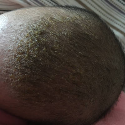 教你了解脂溢性皮炎及其治疗方法