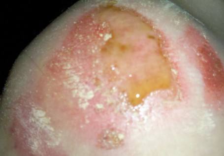 伤口发炎怎么办 帮助伤口愈合的食物