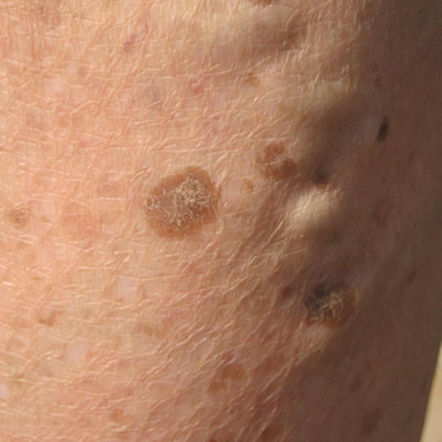 如何治老年斑  你学会了吗