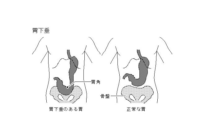 胃下垂病因和最佳的胃下垂治疗方法