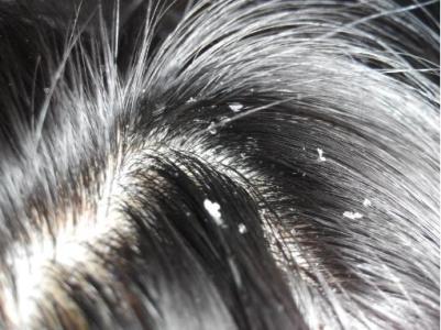 头屑多是什么原因 中医6偏方帮你去头屑