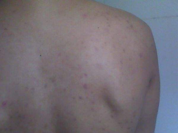 年轻人纠结背部长痘的原因