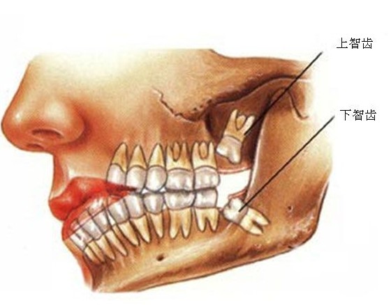 智齿发炎 注重口腔卫生问题