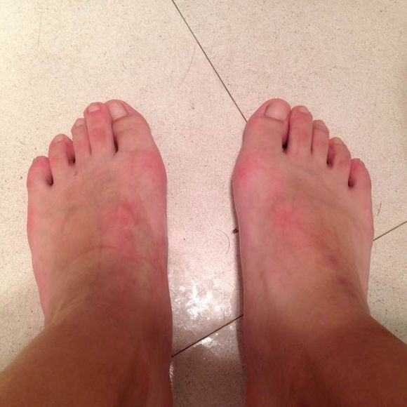 痛风是什么？5大治疗痛风偏方献给你