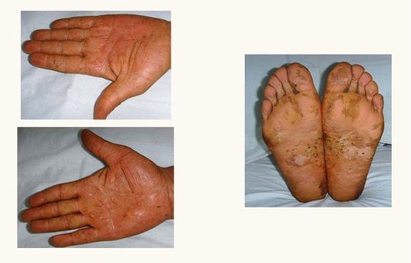 手足癣日常护理措施和治疗工作大全