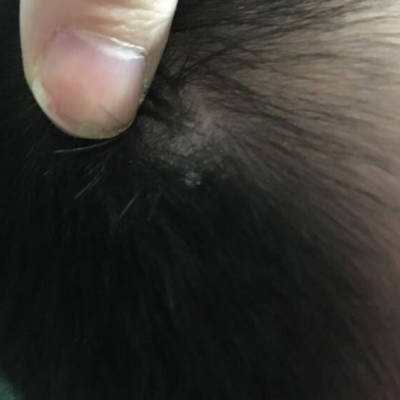 教你了解脂溢性皮炎及其治疗方法