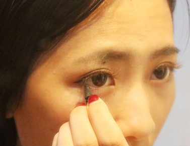 女性脸上长斑是什么原因及正确的治疗方式