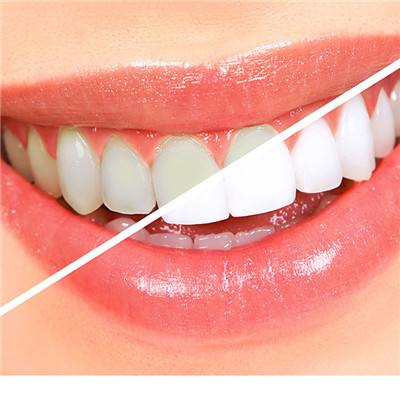 爱美的朋友不要错过，怎么让牙齿变白