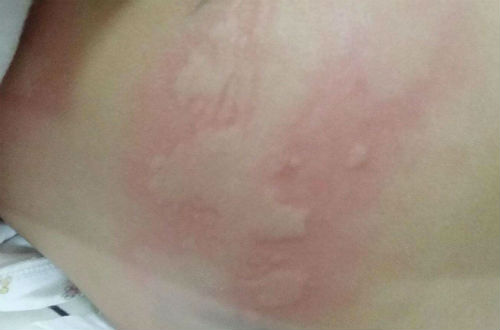 荨麻疹的症状 主要有以下六种