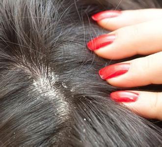 如何快速去除头皮屑 对头皮屑3大误区