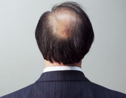 男性防止脱发的方法 这几招不错