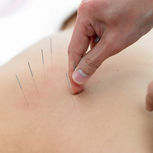 针灸减肥有副作用吗 研究表明存在副作用