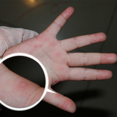 手足口病防治知识与注意事项