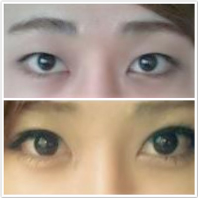做双眼皮的后遗症 会留下疤痕