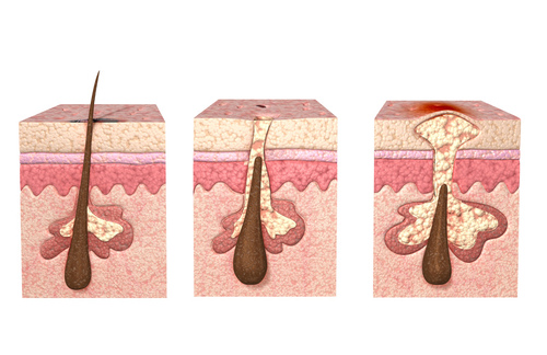 毛周角化症是怎么回事 一种遗传性皮肤病