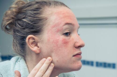 治疗皮肤过敏偏方   五种偏方有奇效