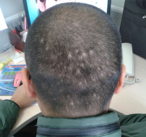 影响形象 斑秃最好的治疗方法介绍