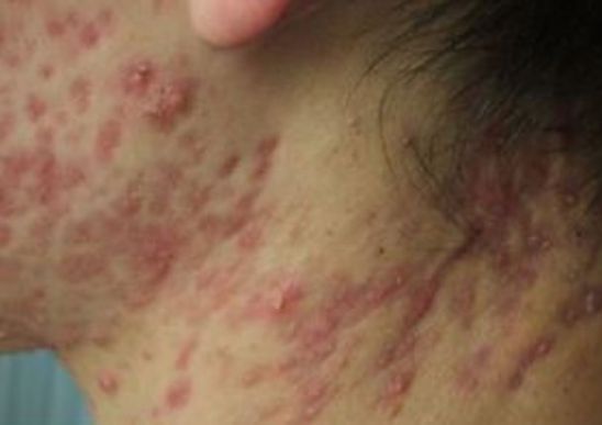 中医治疗痤疮的方法 痤疮病理病因分析