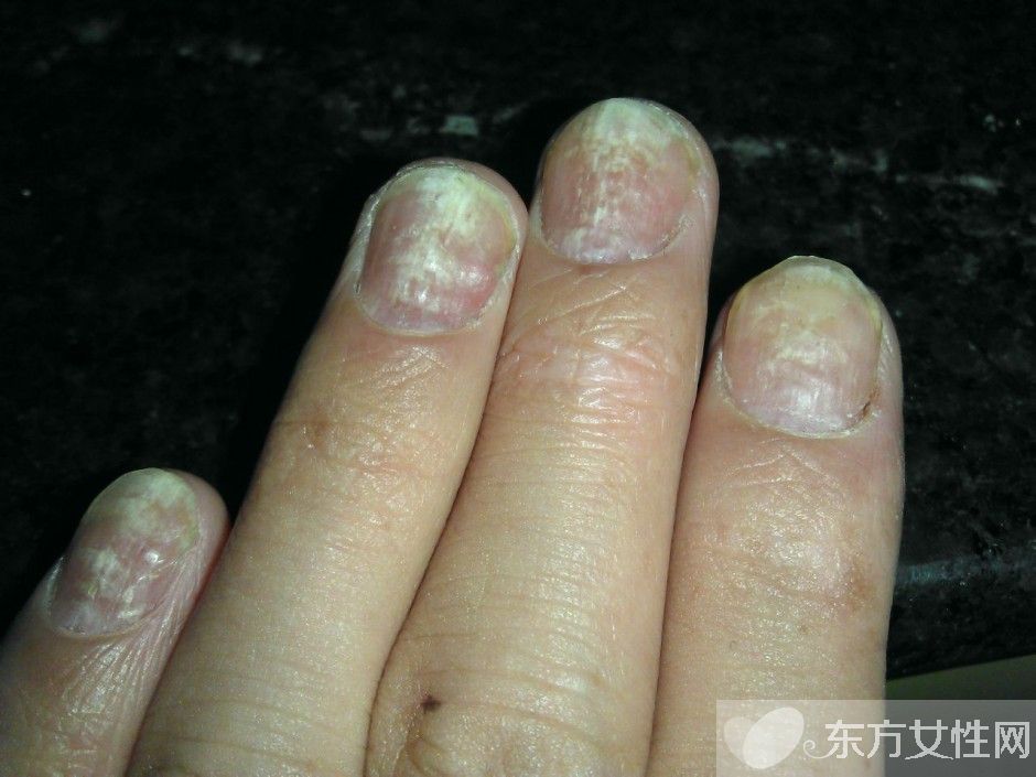 治疗灰指甲偏方有哪些 注意事项不可忘