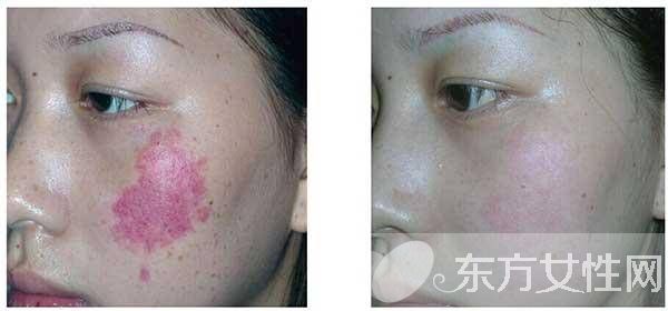 红胎记是什么 胎记怎么去除