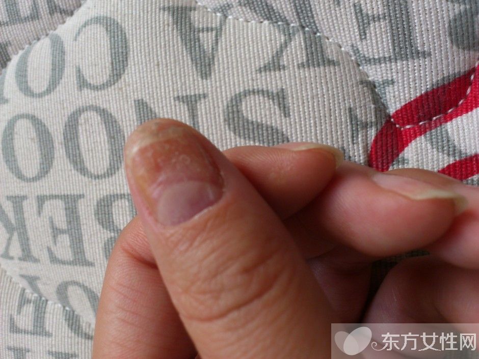 灰指甲会传染吗 灰指甲的护理方法