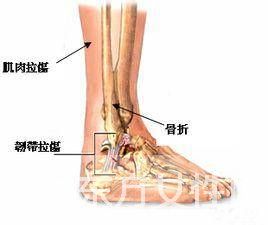韧带损伤如何治疗 韧带损伤的症状