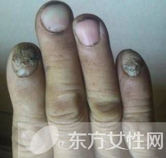 治疗灰指甲偏方有哪些 注意事项不可忘