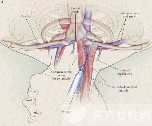 静脉曲张怎么预防 静脉曲张的病因是什么
