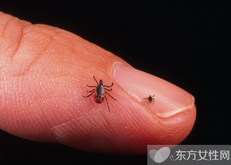 虱子咬的症状有哪些 怎样去除虱子