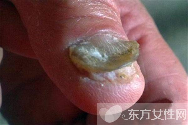 治疗灰指甲偏方有哪些 注意事项不可忘
