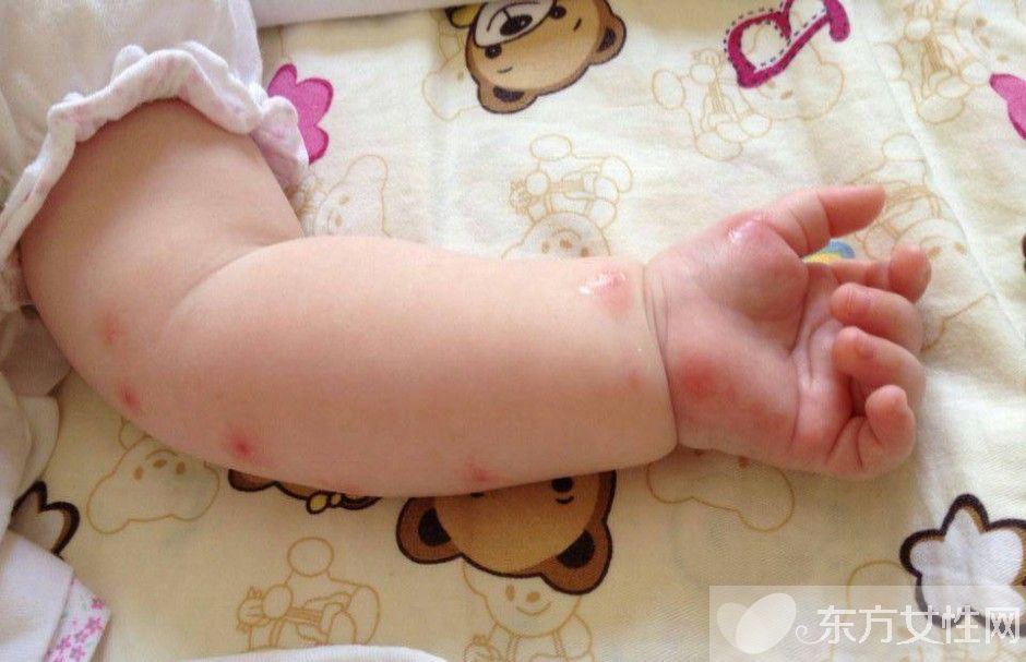 止痒的方法有哪些 常见的4大过敏源