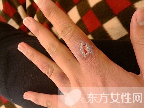 治疗冻疮的方法有哪些 8大方法帮你医治