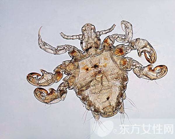 虱子咬的症状有哪些 怎样去除虱子