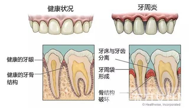 食物塞牙缝怎么办