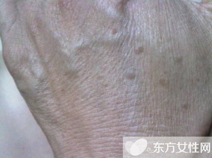 年轻人手上老年斑的原因