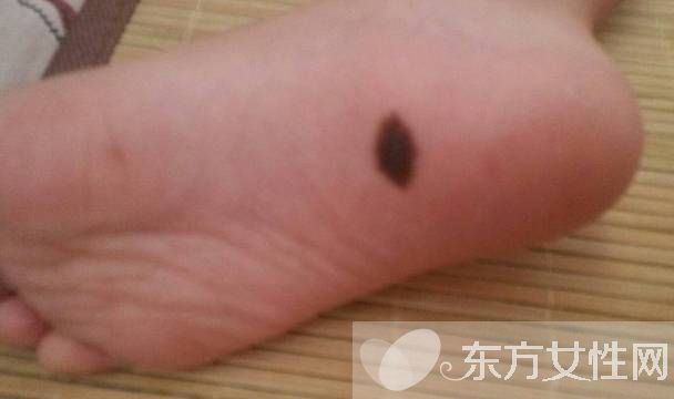 胎记怎么去除 激光去胎记的5大优势