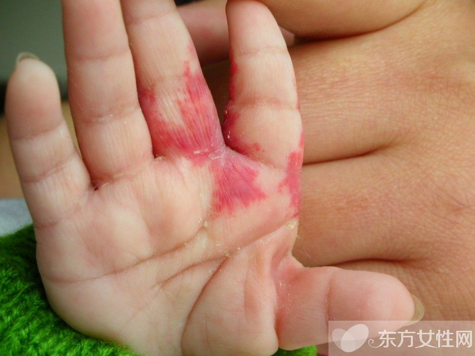 胎记是怎么形成的 胎记对命运也是有影响的哦