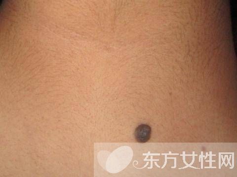 痣是怎么形成的 激光去痣后的6大护理方法