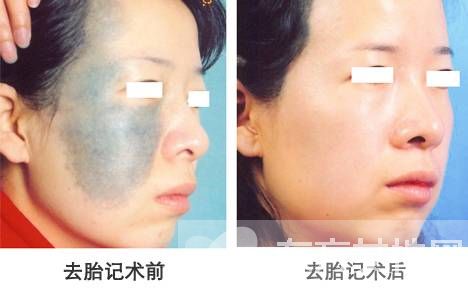 胎记是怎么形成的 怎么去除胎记