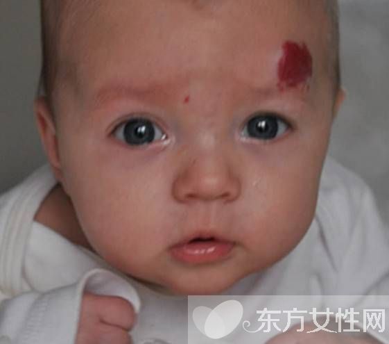 胎记是怎么形成的 怎么去除胎记