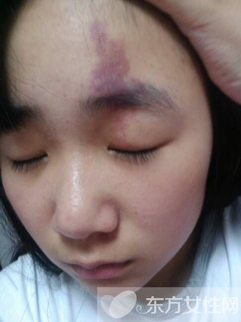 胎记怎么去除 激光去胎记的5大优势