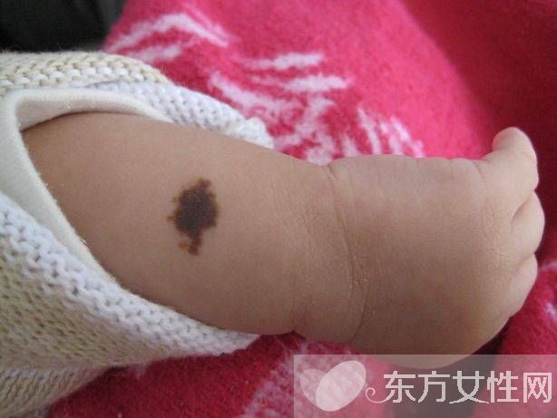 胎记是怎么形成的 胎记对命运也是有影响的哦