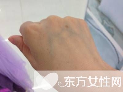 年轻人手上老年斑的原因