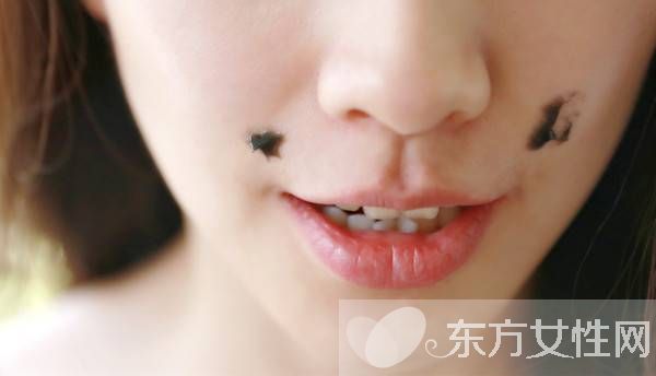 痣是怎么形成的 激光去痣后的6大护理方法