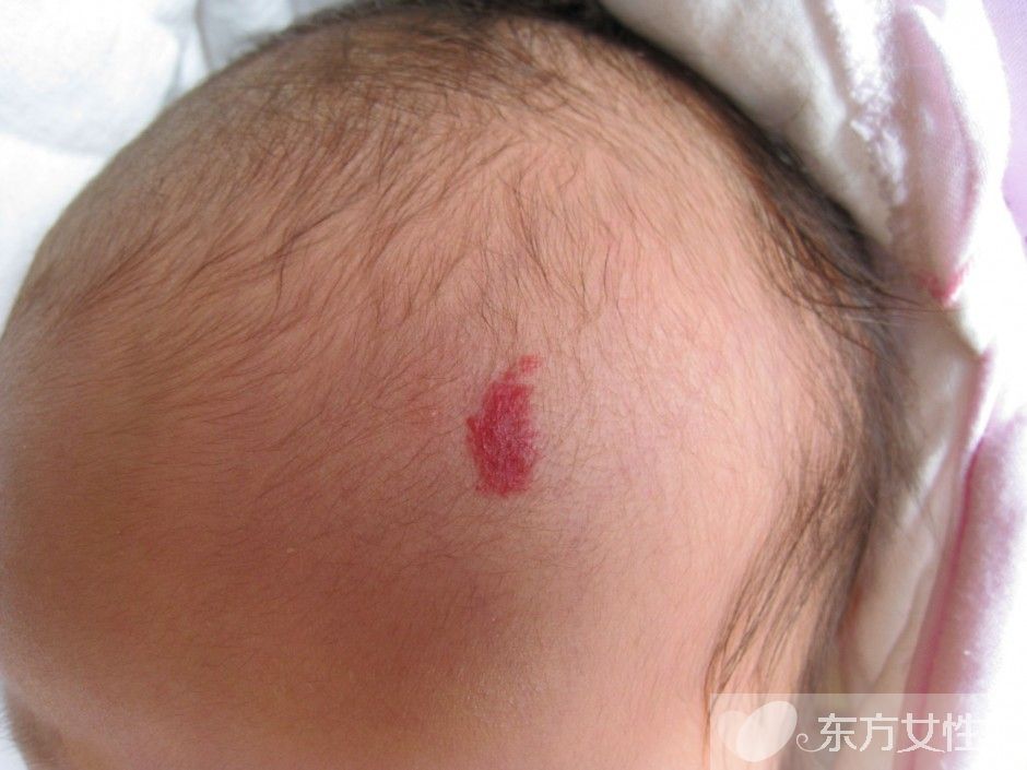 胎记是怎么形成的 胎记对命运也是有影响的哦