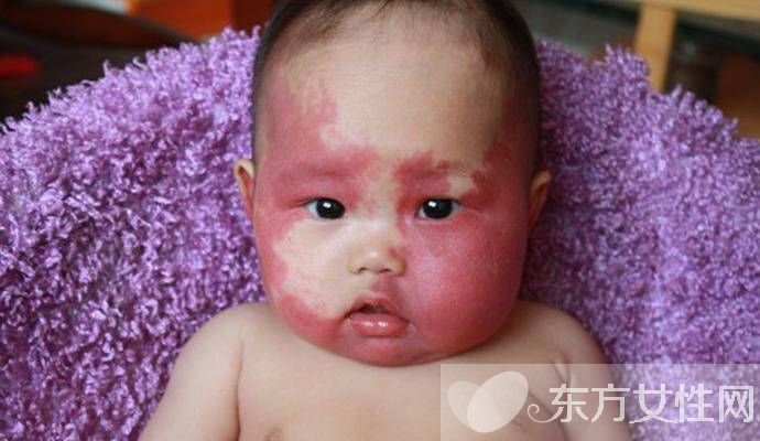 胎记是怎么形成的 胎记对命运也是有影响的哦