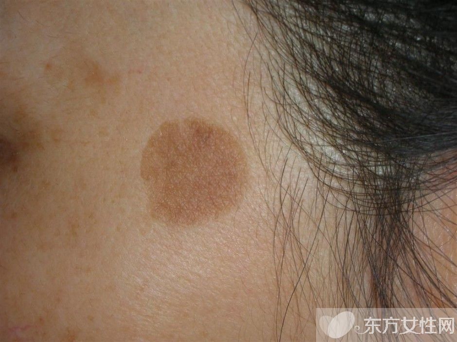 老年斑怎么去除 这些日常祛斑小窍门你记住了吗