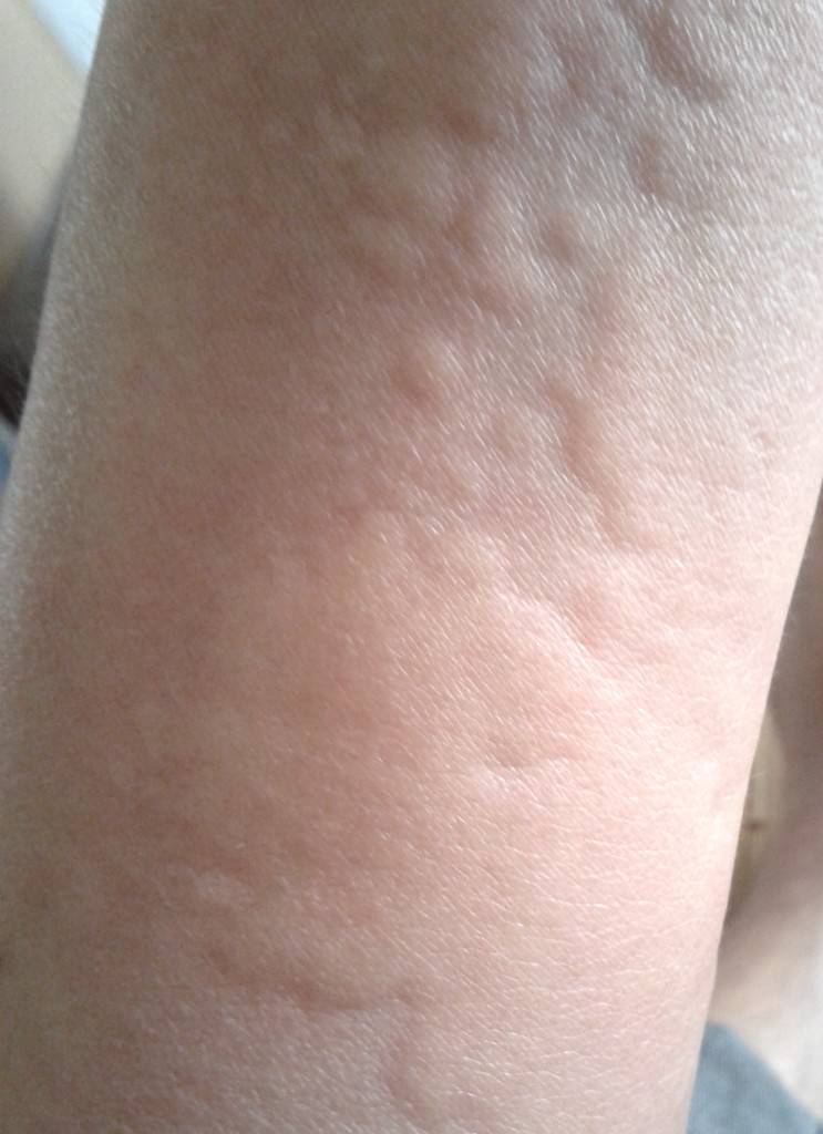 海鲜过敏怎么办 预防海鲜过敏的方法