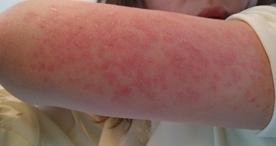 紫外线过敏怎么办 它有哪些症状表现