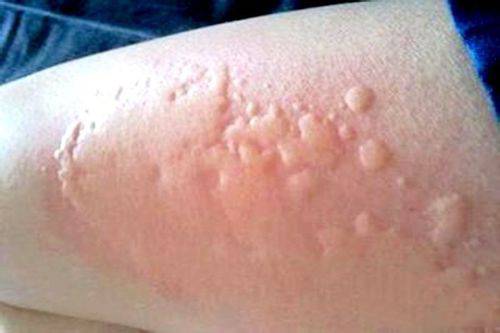 海鲜过敏怎么办 预防海鲜过敏的方法